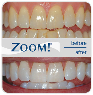 Perfect Smile ZOOM Bleaching